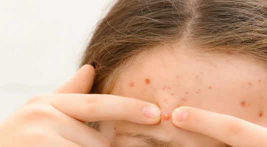 The Triggers of Seborrheic Dermatitis: Insights from Recent Research
