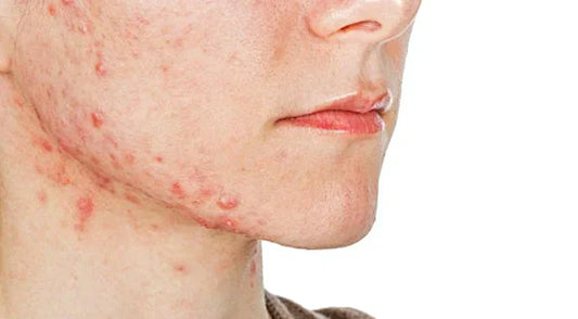 Can Phototherapy Treat Rosacea? A Comprehensive Overview Based on Current Research