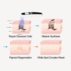 ZJZK Portable 308nm Excimer UVB Light- Vitiligo/Psoriasis Light Therapy Device
